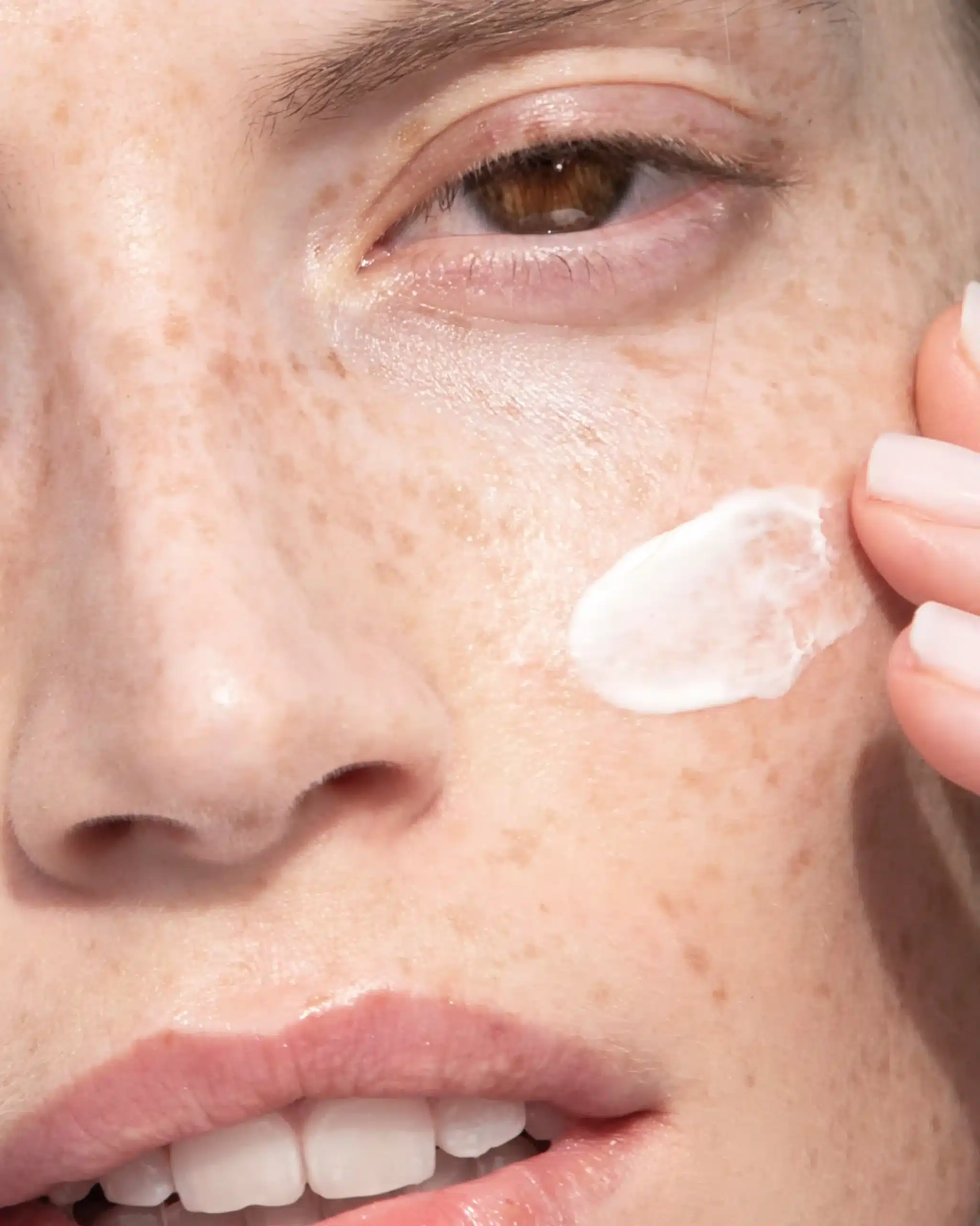 Hyperpigmentation chanand scaled